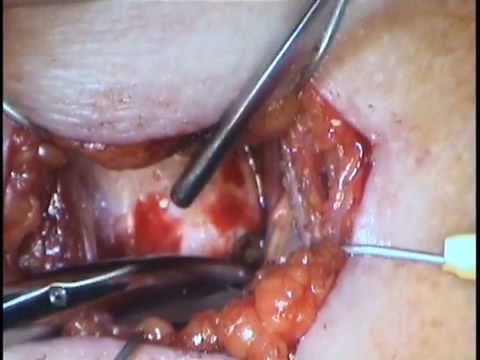 Laryngology 101 - Medialization Laryngoplasty