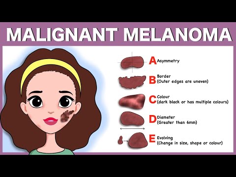 Malignant melanoma: Signs, Pathophysiology, Types, Diagnosis, Treatment