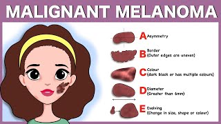 Malignant melanoma: Signs, Pathophysiology, Types, Diagnosis, Treatment