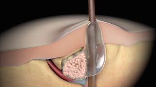 Acne: Understanding the Types of Acne and Treatment Options