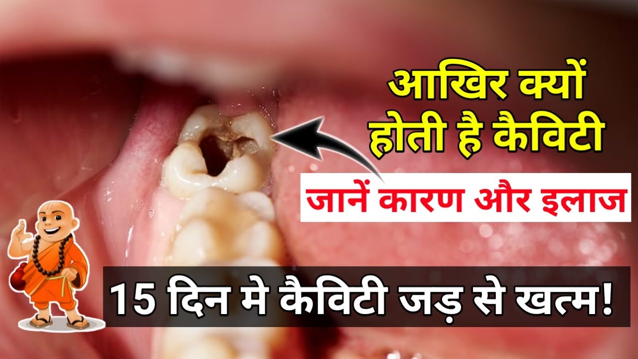 15 दिन मे दांत की Cavity का इलाज How to Get Rid of Tooth Cavity