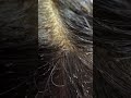 lice infestation #headliceremoval #licecomb #headlice #headlicetreatment #hairlice #haircare #hair