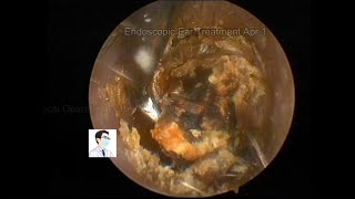 Regular cleaning of cholesteatoma of the external ear and postoperative reexamination,20230401