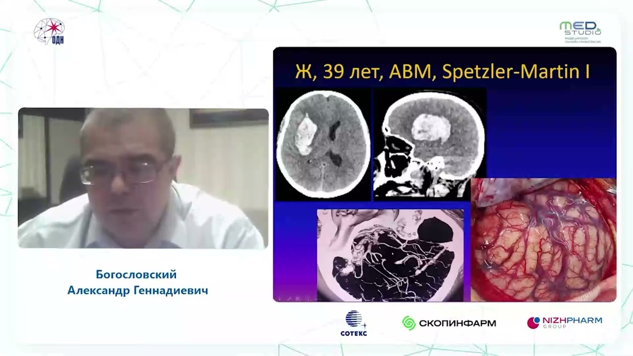 Полушарная внутримозговая гематома: когда нужно оперировать. Богословский А.Г.