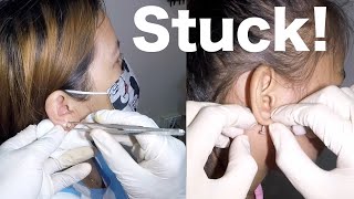 How to Remove Earring Stuck in Mom and Daughter's Earlobe by Earwax Specialist 9,694 views 2 months ago 2 minutes, 14 seconds