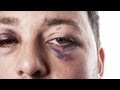 How to Treat a Black Eye | First Aid Training