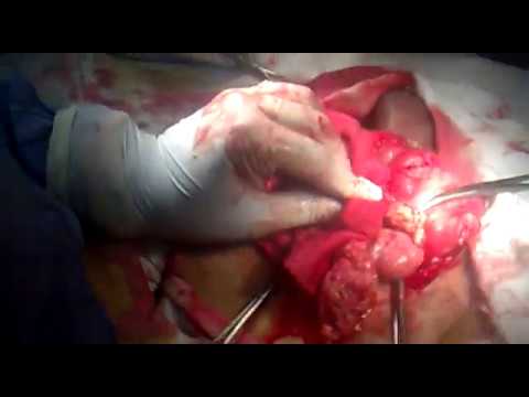 incarcerated hernia