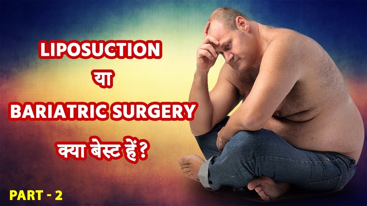 LIPOSUCTION vs BARIATRIC SURGERY (Hindi) WHAT TO CHOOSE? (Part 2