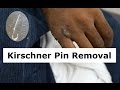 Kirschner Wire Removal Procedure