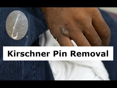 Kirschner Wire Removal Procedure