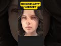 |Rhinoplasty surgery|#Rhinoplasty#NoseJob#RhinoplastySurgery#NoseSurgery#RhinoplastyDoctor