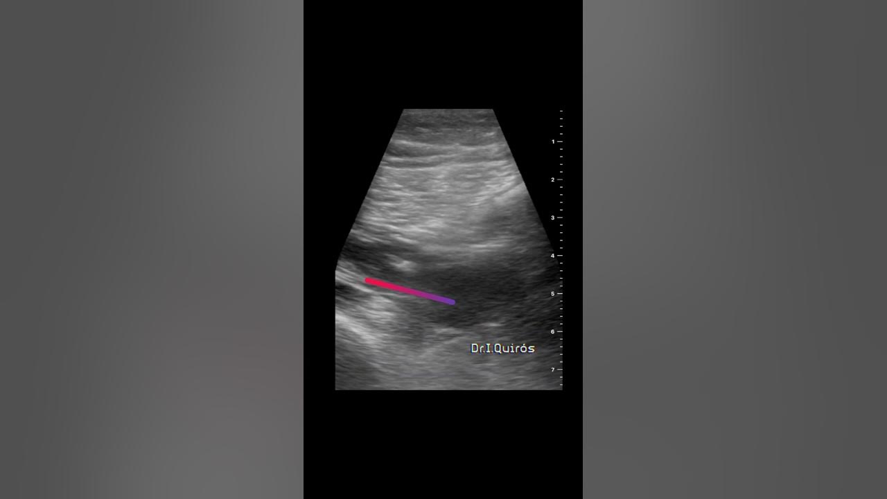neurontin para nervio ciatico