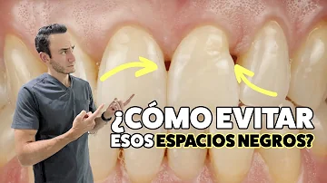 ¿Por qué tengo triángulos negros entre los dientes?