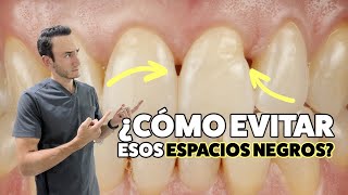 Do you have black triangles/gaps between your teeth? This could be your solution!