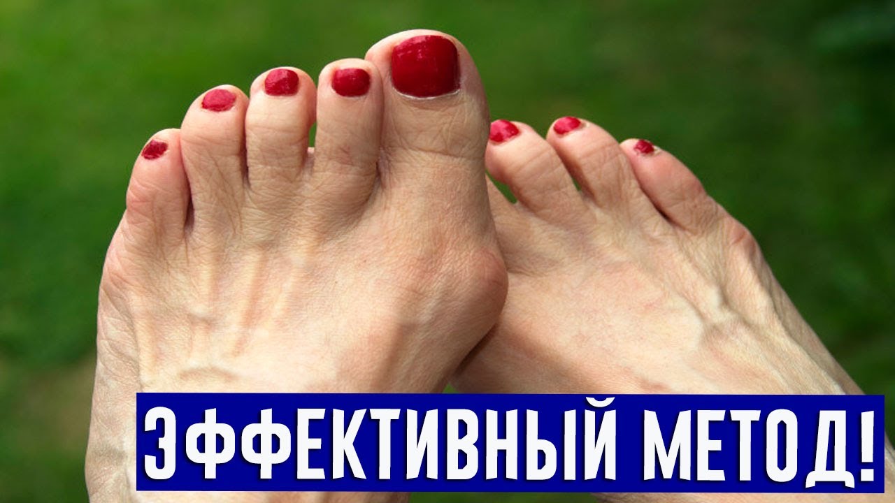 УМЕНЬШИТЕ в 2 раза косточку на ноге у большого пальца за неделю! - YouTube