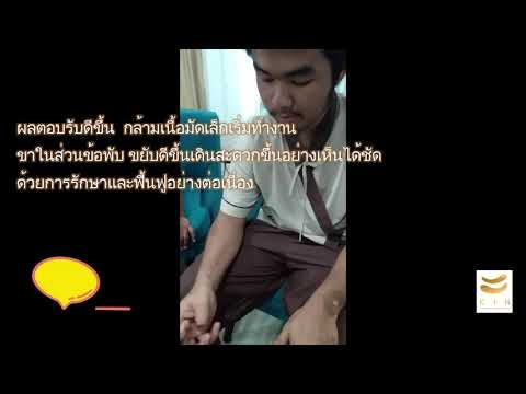 rTMS ฟื้นฟูสมองหลังอุบัติเหตุศีรษะกระแทก ประสบการณ์จริง