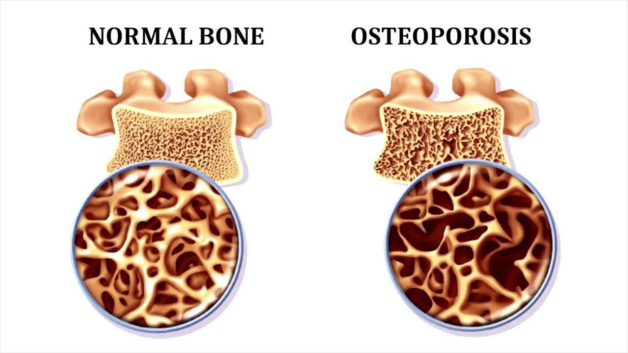 Улучшает кости. Остеопороз. Остеопороз кость. Кость при остеопорозе. Здоровая кость и остеопороз.