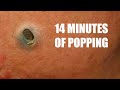 157 Cysts, Abscesses and Pimples!  Comedones and Whiteheads