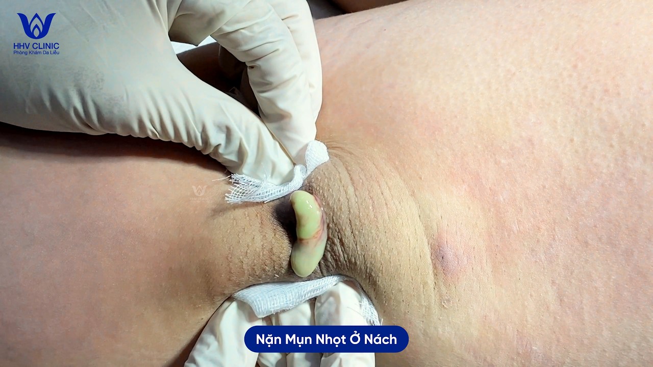TỔNG HỢP NẶN NHỮNG CA MỤN NHỌT Ở NÁCH - SIÊU TO KHỔNG LỒ.