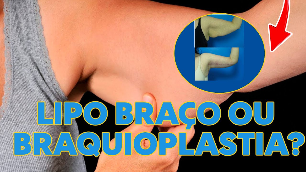 FLACIDEZ NO BRAÇO  LIPO DE BRAÇO OU BRAQUIOPLASTIA? 