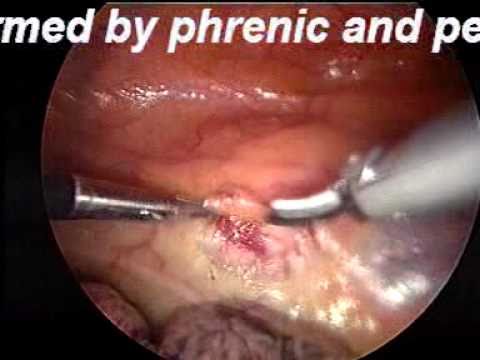 VATS Thoracoscopic Thymectomy