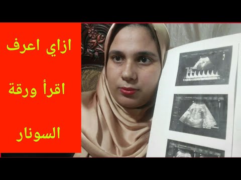 كيف اعرف نوع الجنين من ورقة السونار ؟