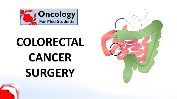 Colorectal Cancer Surgery: principles and types - DayDayNews