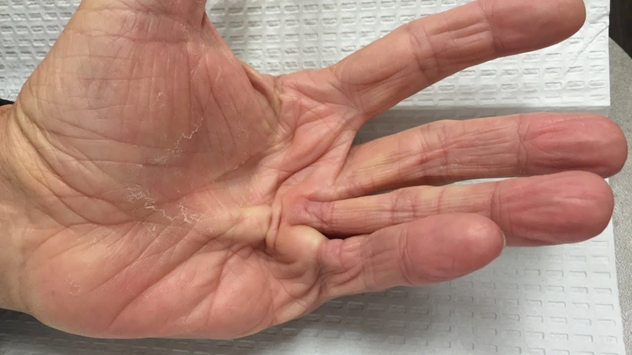 I can't straighten my fingers - Dupuytren's - Oh My Arthritis