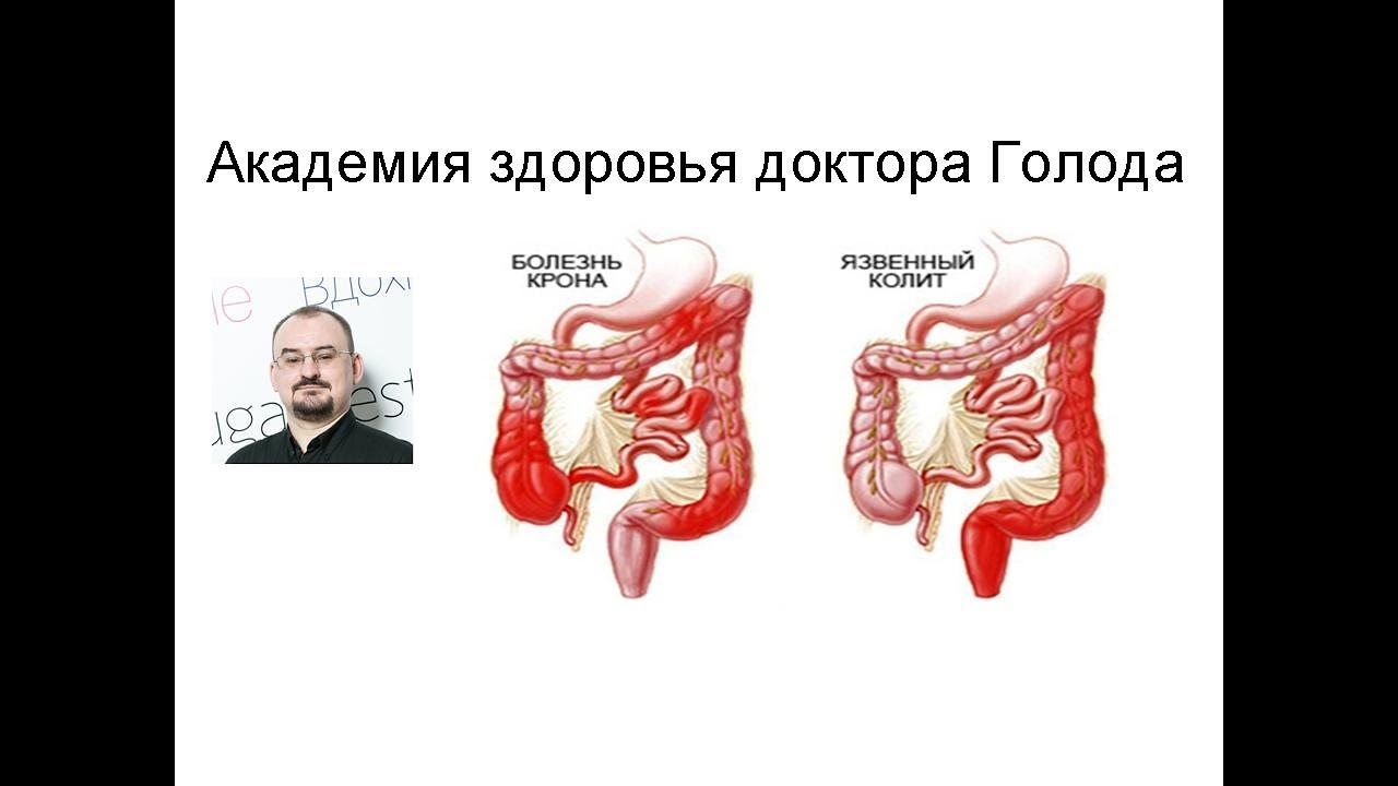 Неспецифический язвенный колит и болезнь Крона. - YouTube