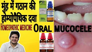 Mucocele ! Homeopathic medicine for Oral mucocele ? screenshot 3