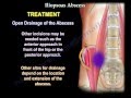 psoas Abscess infection, A Diagnostic Dilemma - Everything You Need To Know - Dr. Nabil Ebraheim