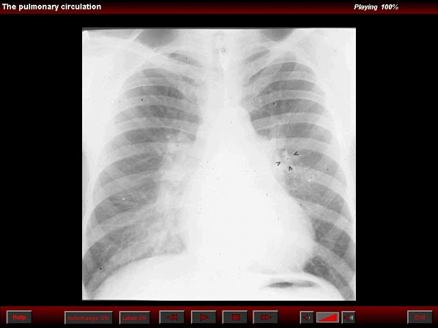pulmonary edema and conditions simulating edema   pulmonary edema   interstitial edema