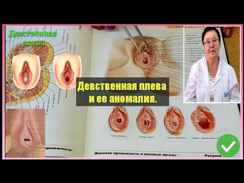 Девственная плева и ее аномалия (hymen).