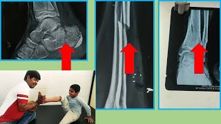 Amazing Chiropractic Adjustment India | Heel, Arm, Hand, Fracture Treatment By Indian Chiropractor