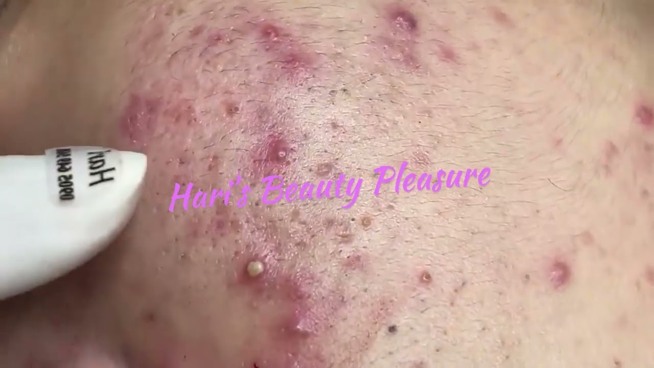 Pimples/Whiteheads Removal with Hari's -  Satisfying