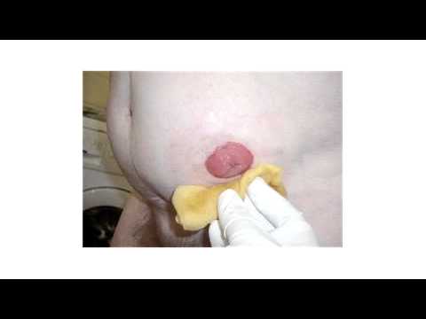 Video: Stádium 4 Rakoviny Plic: Příznaky A Léčba. Rakovina Plic Stupeň 4: Prognóza