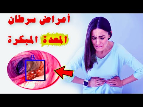 ماهي أعراض سرطان المعدة المبكرة ؟