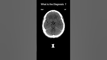 Tentorium cerebelli - CT brain/axial image CT Brain Anatomy Meninges Quiz 12#@radiologychannel007