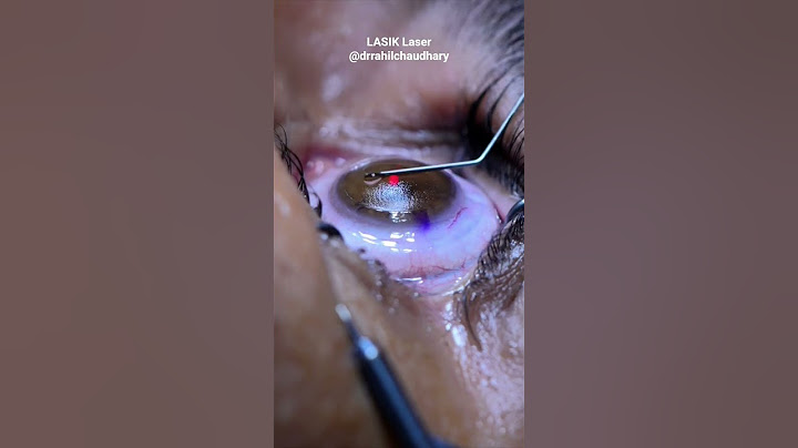 How LASIK Laser eye surgery is done #lasik #lasereyesurgery #lasiksurgery #lasikeyesurgery