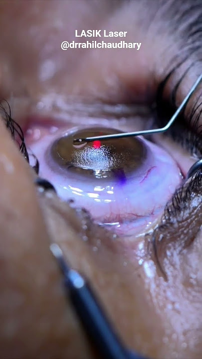 How LASIK Laser eye surgery is done #lasik #lasereyesurgery #lasiksurgery #lasikeyesurgery