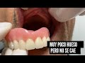 Intentamos retirar esta prtesis y no se movi   misterdent dentista