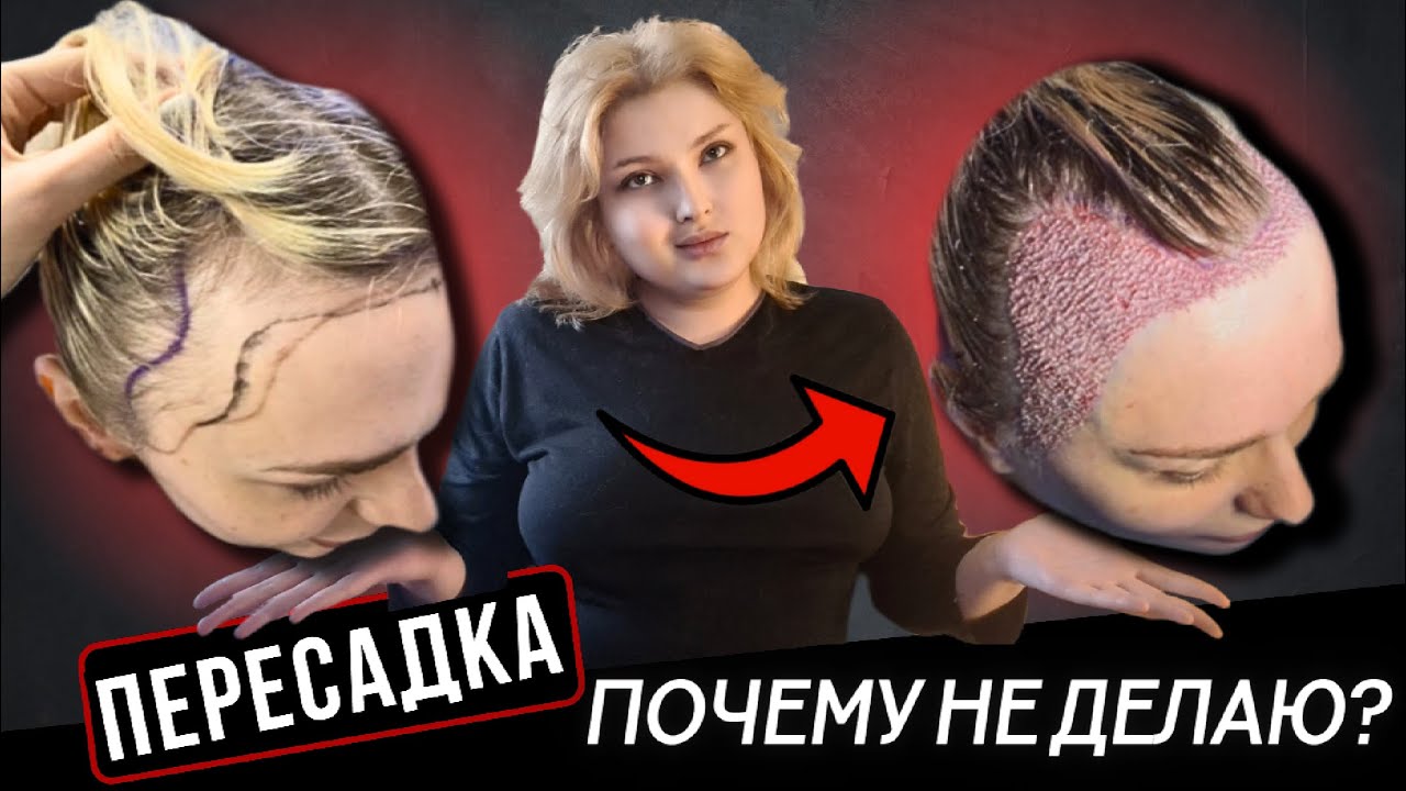 Андрогенная алопеция у женщин | Почему я НЕ делаю пересадку волос ...