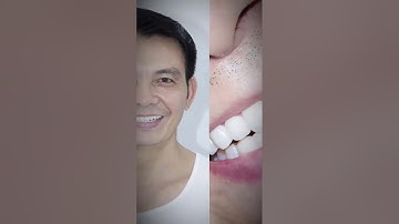 Trả lại nụ cười tự tin nhờ răng sứ thẩm mỹ.  #shorts #viral