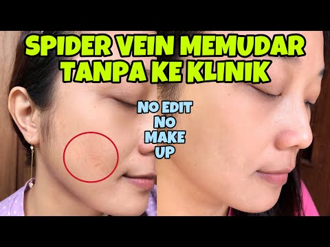 URAT HALUS DI WAJAH MEMUDAR TANPA KE KLINIK! CARA MENGATASI SPIDER VEIN DENGAN PERAWATAN DI RUMAH!!!