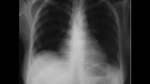 Pulmonary Manifestations in SLE - Dr.Rajesh Gubba