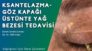 Ksantelazma - Göz Kapağı Üstünde Yağ Bezesi Tedavisi