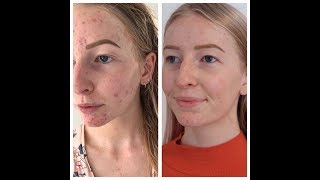 Kate's relief from two years of persistent acne, thanks to LOVESKIN