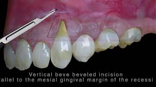 Vídeo 3D Completo - Colgajo Desplazado Lateralmente Y Coronalmente