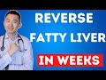 The FASTEST Way to Reverse Fatty Liver, Naturally | NAFLD Treatment