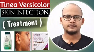 Tinea Versicolor Treatment Cream | How To Treat Tinea Versicolor At Home